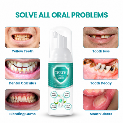 🔥 LAST DAY SALE 70% OFF 🔥 NEW TEETH Mouthwash - Solve all Oral Problems